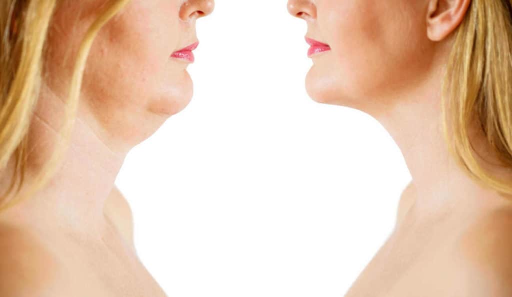 Double Chin treatment Stockport before and after results
