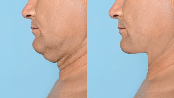 Which Non-Surgical Treatments Work Best for Jowls and Loose Skin Stockport?