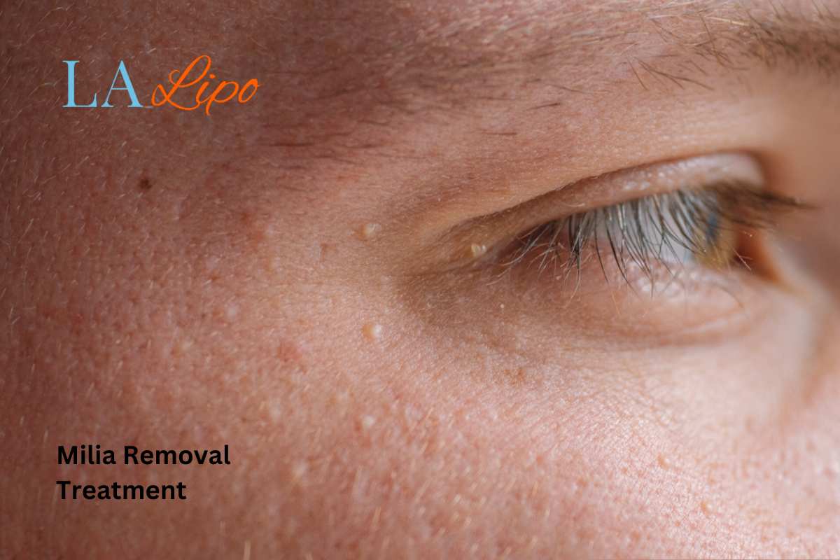 Cryopen Milia Removal: Is It the Easiest and Safest Option Stockport?