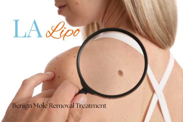 Woman having her inspection of blemish before mole removal Stockport