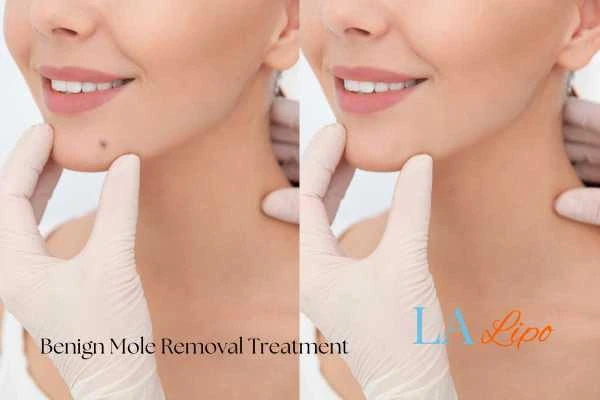 woman's before and after mole removal Stockport results