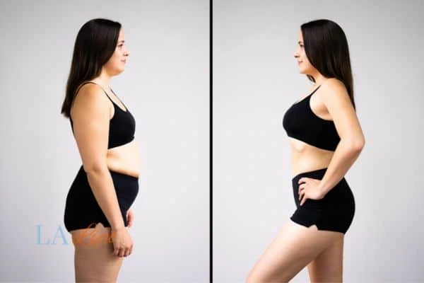 image of woman before and after results of LA-EMS Body Sculpting Stockport to help treat Diastasis recti