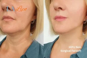 hi-fu for wrinkles Stockport before and after results