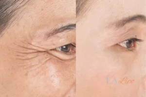 Before and after results of woman - HI-fu wrinkles reduction treatment Stockport