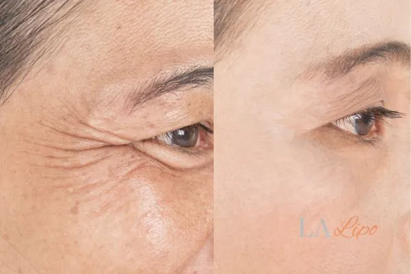 Before and after results of woman - HI-fu wrinkles reduction treatment Stockport