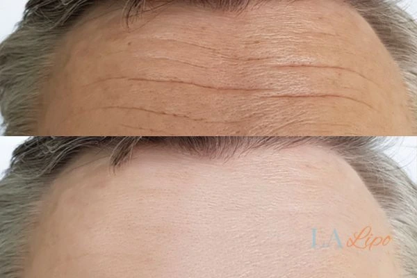results of HIFU Stockport on mans forehead to help reduce lines and wrinkles