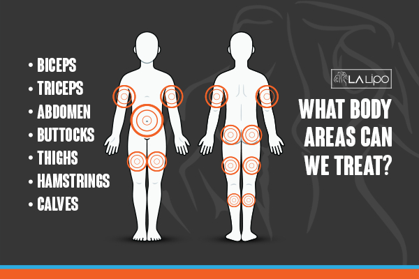 Graphic to show areas you can have LA-EMS Body Sculpting Stockport treatment.