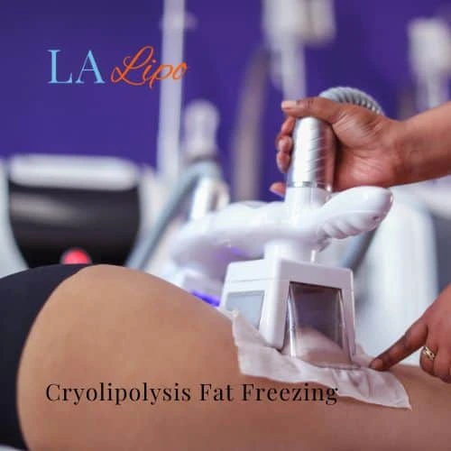 fat freezing - Cryolipolysis Stockport