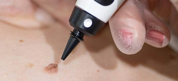 skin tag removal using cryopen Stockport