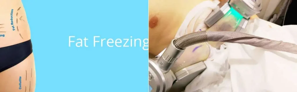 Fat freezing Stockport on multiple areas of the body
