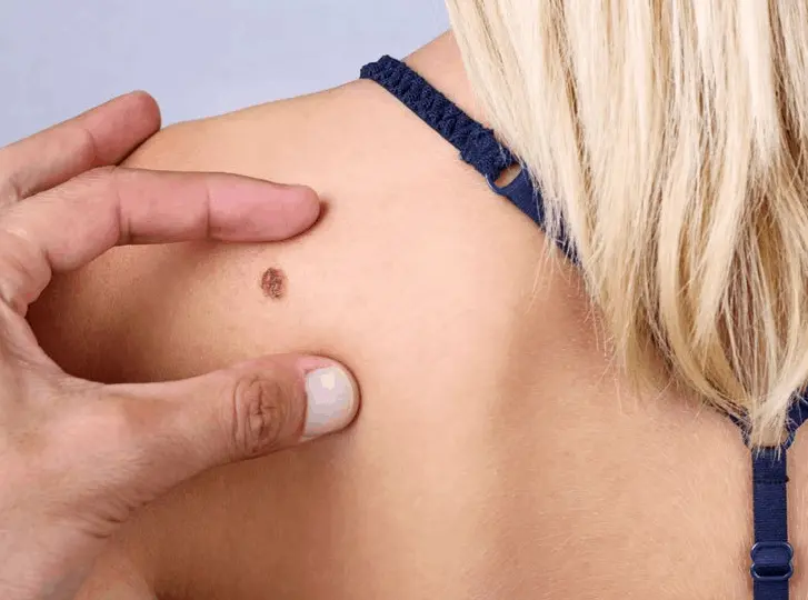 woman having mole removal Stockport consultation before treatment.