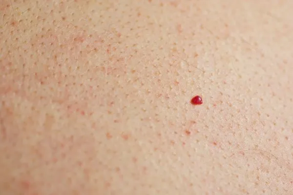 close up of a cherry angioma Stockport