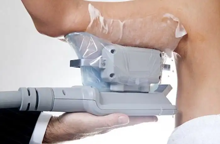 Picture of fat freezing Stockport on the upper arms.