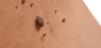 image of a skin tag Stockport