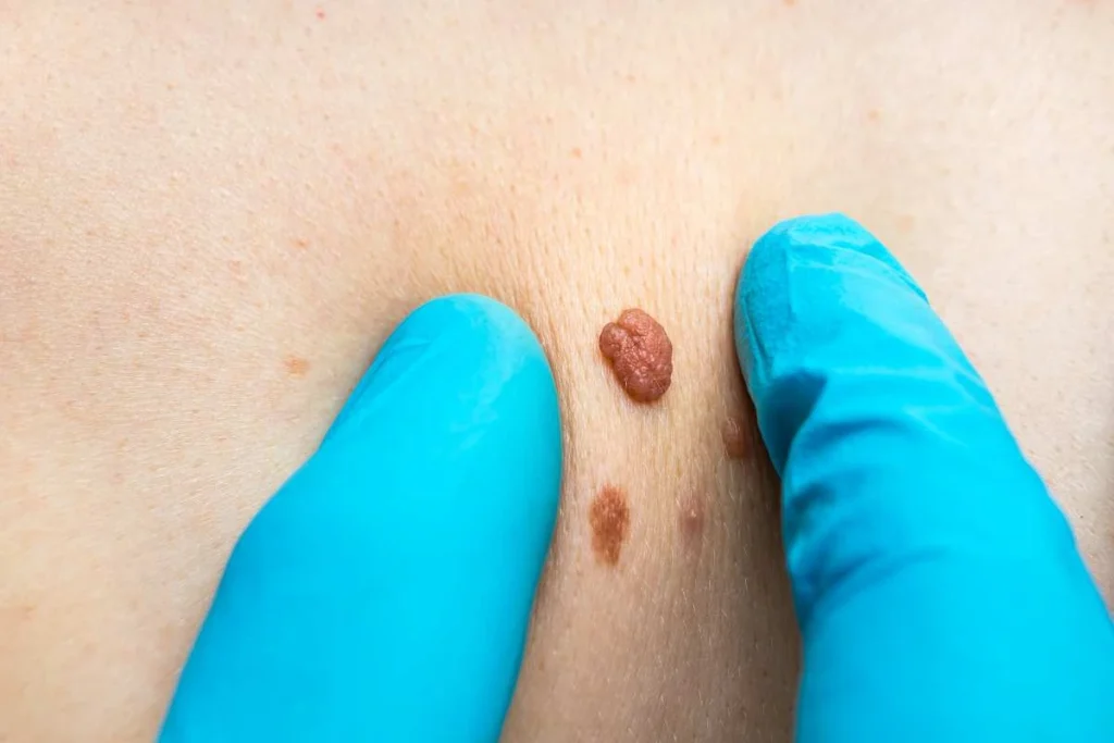 Consultant examining a skin tag Stockport