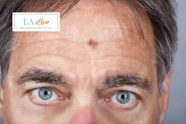 Solar Lentigo Removal Stockport image of man with mark on his forehead