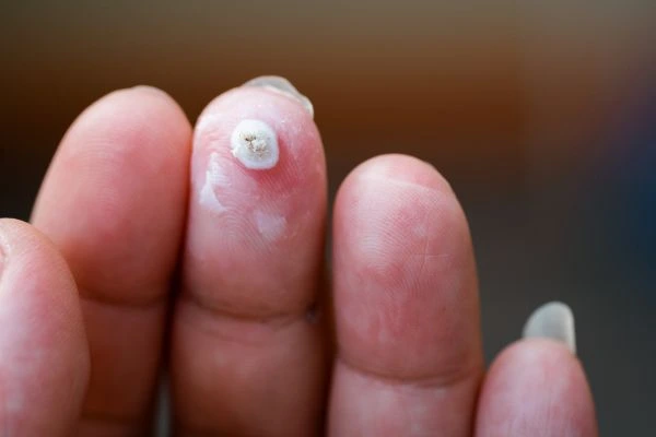 wart on person finger - cryotherapy to treat from LA LIPO Stockport