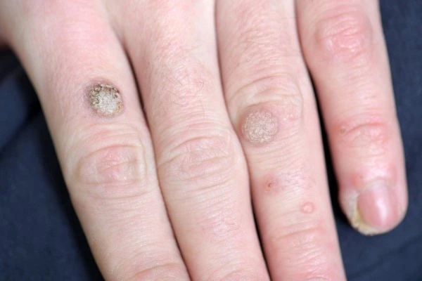 photo of warts on person hand - see wart removal Stockport from LA LIPO