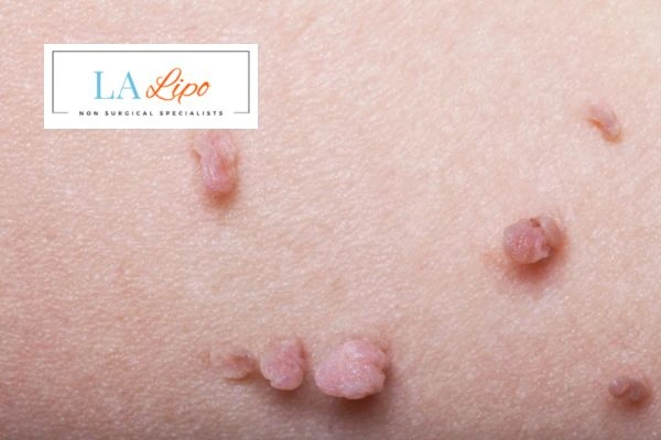 Does cryopen skin tag removal Stockport hurt? Find out now call our team today!
