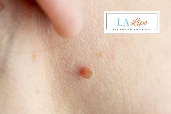 Book skin tag removal Stockport today speak to our team now!