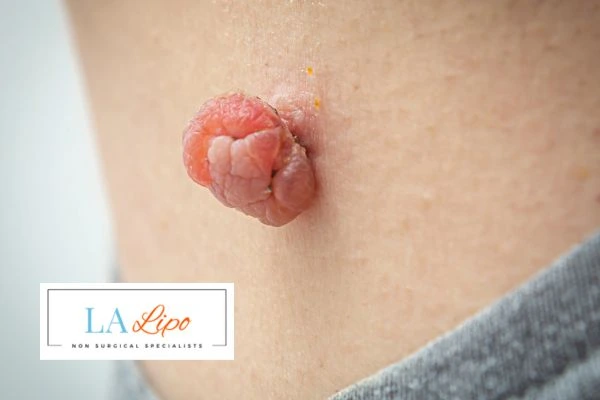 Interested in skin tag removal Stockport? Concerned about the pain? Find out more today!