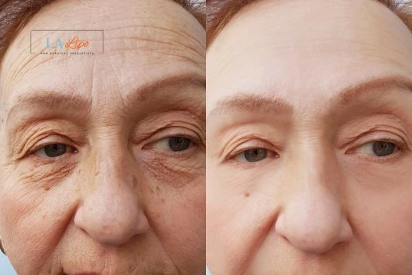 The powerful benefits of Morpheus8 Treatment Stockport - Call Our team today!