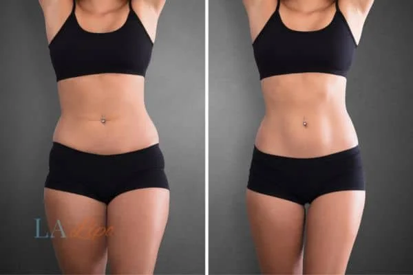 before and after results of non-surgical treatment to help a woman's body image and mental health Stockport