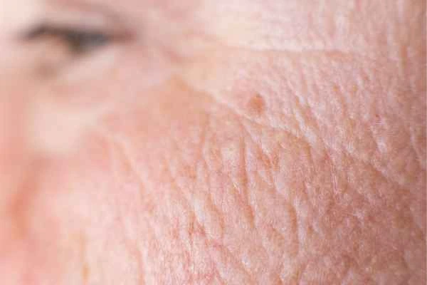 close up picture of a woman's face showing an age spot Stockport