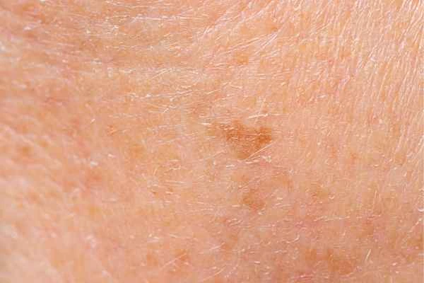 close up picture of age spots Stockport