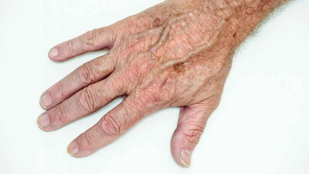 Male hand showing age spot Stockport