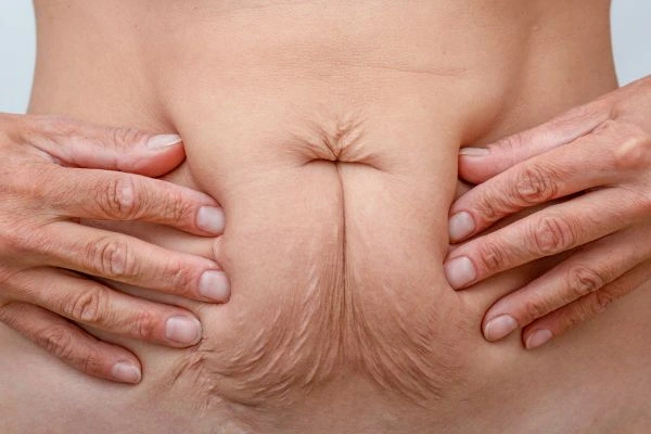 Image of a woman's stomach with loose skin - example of skin tightening Stockport options