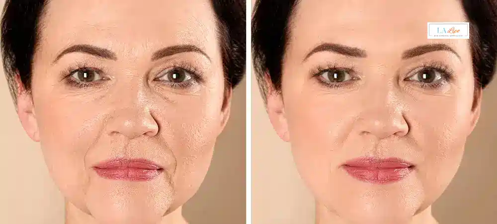 How Long Does It Take to See Results and How Long Do They Last Stockport?